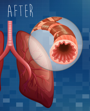 بعد علاج مرض الانسداد الرئوي المزمن (COPD).